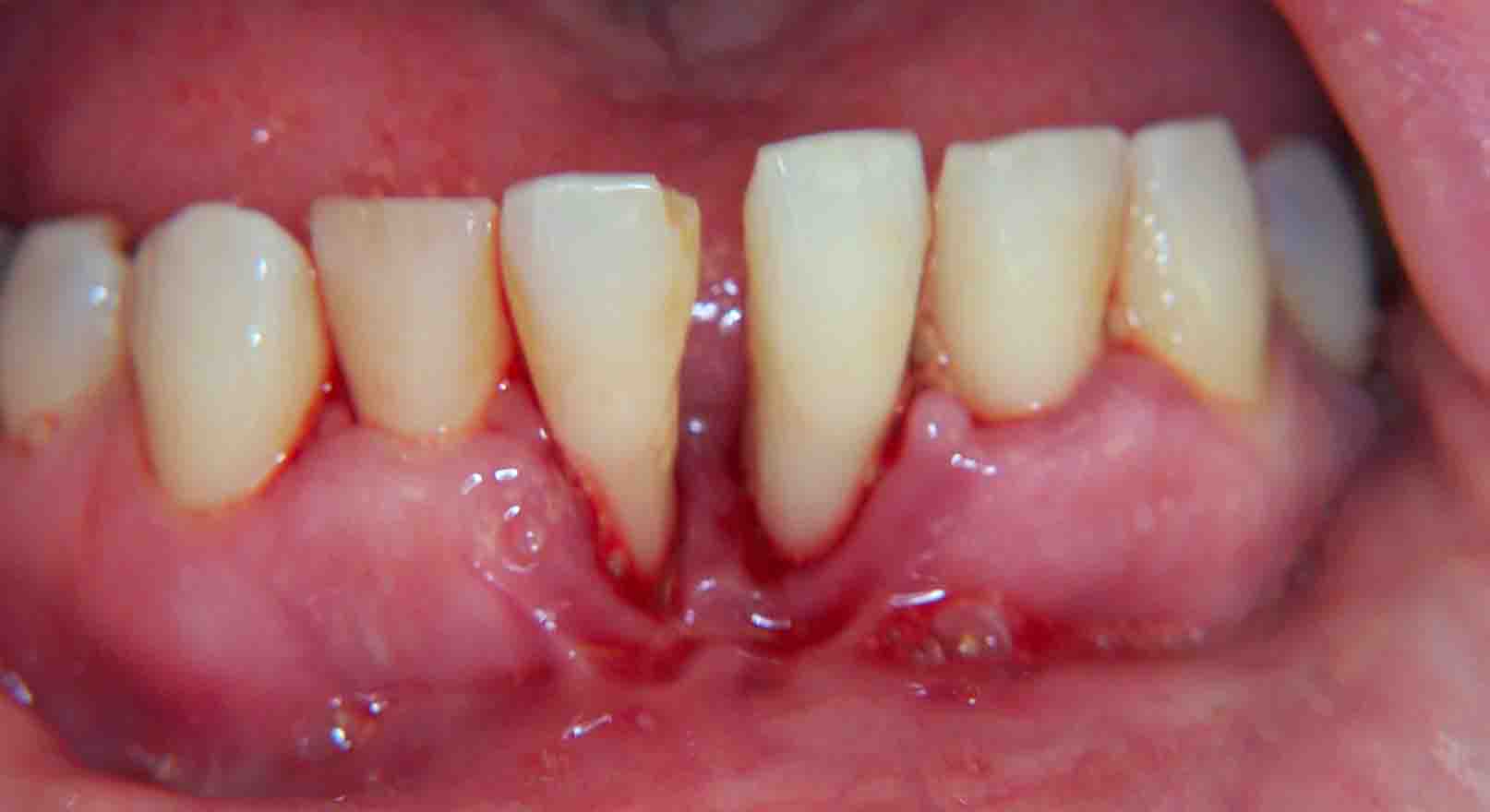 Gum disease