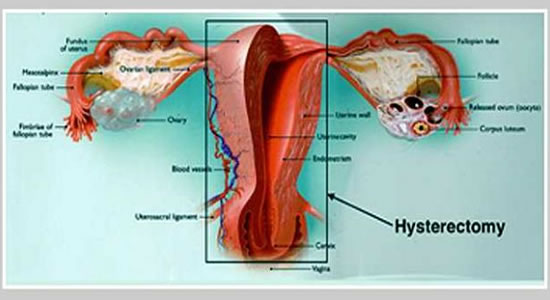 Hysterectomy