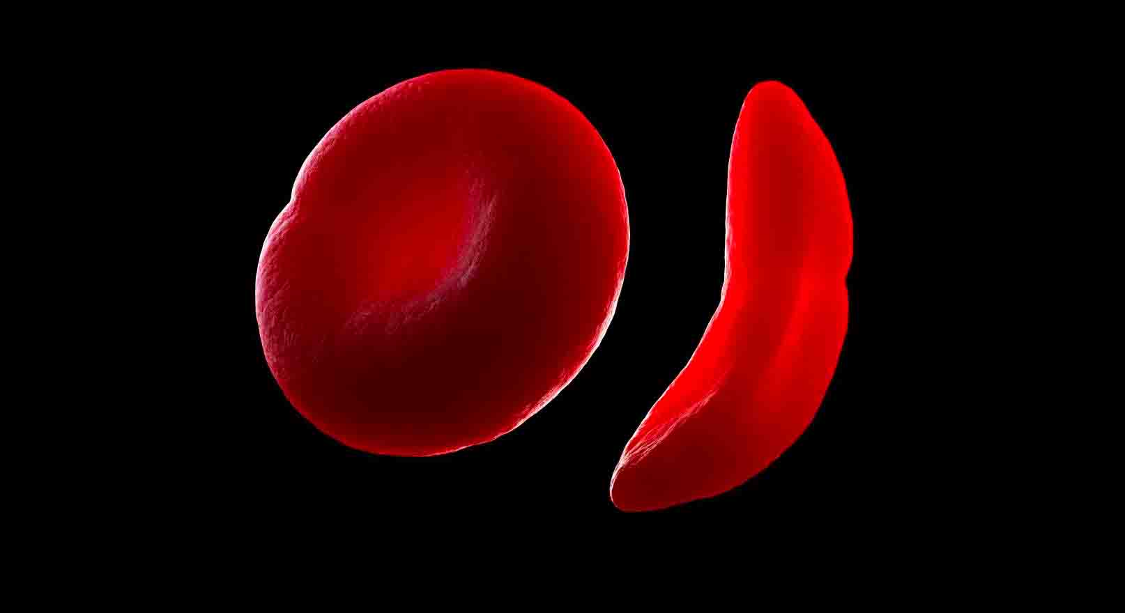 Sickle cell